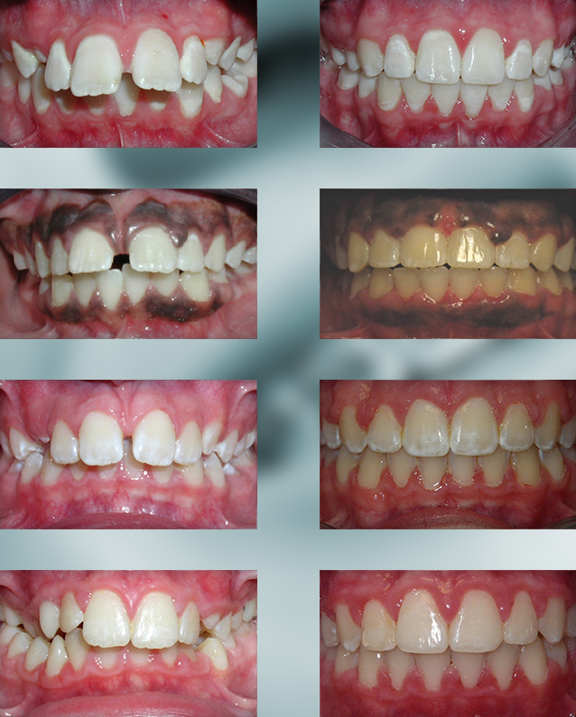Michael-Riordan-Orthodontics-Before-After-1