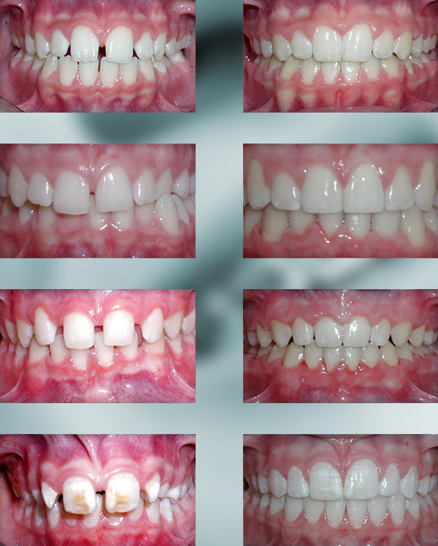 Spacing Teeth